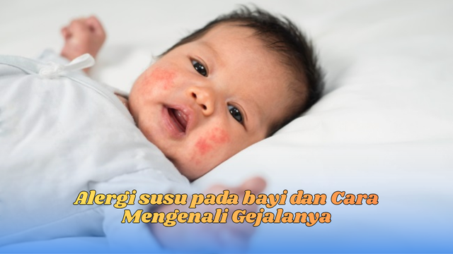 Alergi Susu Pada Bayi